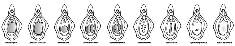 Hymen